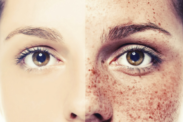 អាចម៍រុយ​ ធ្វើឱ្យ​អ្នក​ខ្មាសគេ​ណាស់​មែន​ទេ?