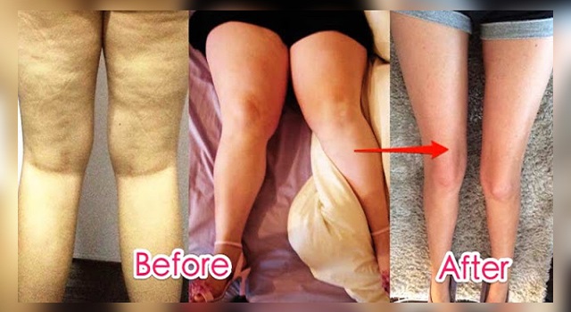 ណែនាំ​វិធី​បំបាត់​ខ្លាញ់​គល់ភ្លៅ​យ៉ាង​មាន​ប្រសិទ្ធភាព​បំផុត