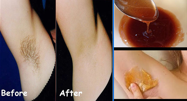 ស្បែក​ក្លៀក «ស» ស្អាត គ្មាន​រោម ដោយ​ប្រើ​រូបមន្តងាយៗ