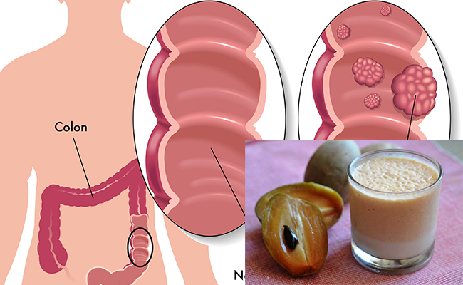 ទឹកល្មុត ការពារជំងឺមហារីកពោះវៀនបាន