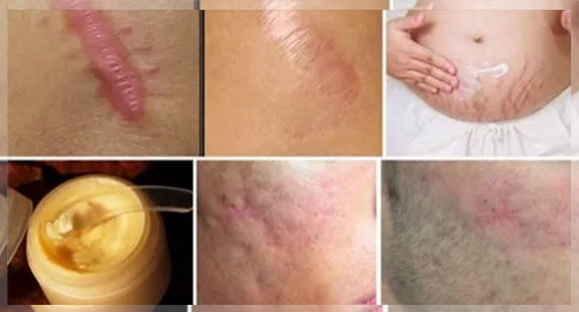 វិធី​បំបាត់​ស្នាម​សម្លាក​ផ្លែ និង​សង្វារ​នៅលើ​ដងខ្លួន