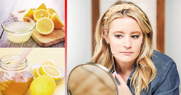 វិធីព្យាបាលស្នាមសន្លាក ក្នុងរយៈពេលខ្លីបំផុត