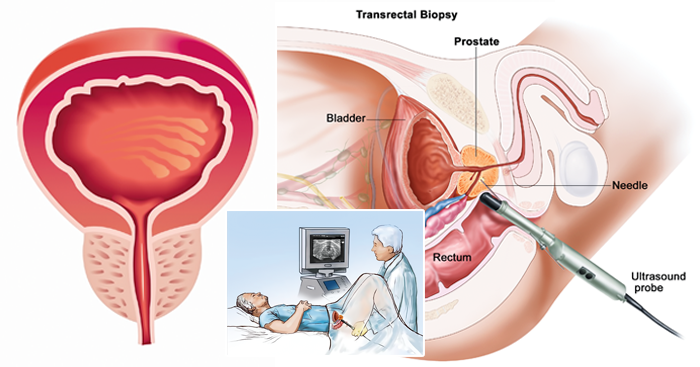 ជំងឺ​រលាក​ពងស្វាស គ្រោះថ្នាក់​អាក្រក់​បំផុត​ដែល​បុរស​ត្រូវ​ប្រុងប្រយ័ត្ន