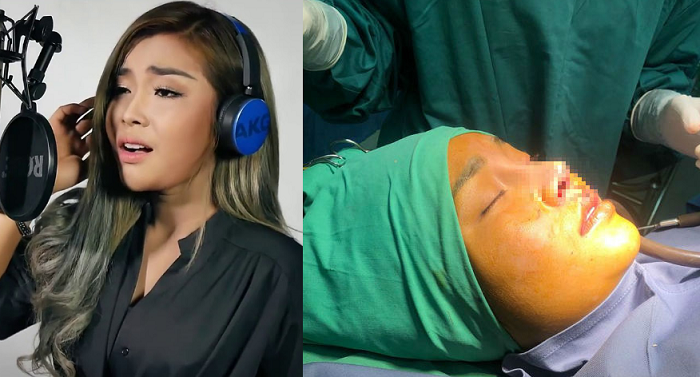 ស្អាតម្លឹងហើយ កញ្ញា បាន មុន្នីល័ក្ខ នៅវះកាត់ក្ដោងច្រមុះបន្ថែមទៀត?