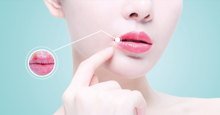 រដូវរងា ប្រេះ​បបូរមាត់ ស្ងួត​ចេញឈាម គួរ​អាន​អត្ថបទ​នេះ