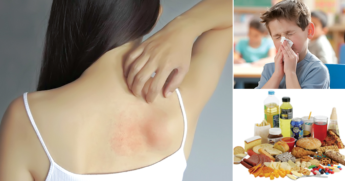 “ប្រតិកម្ម​ចាញ់​អាហារ​” និង​គ្រប់​រឿង​ដែល​អ្នក​អាច​មិនទាន់​ដឹង​ និង​គួរតែ​ដឹង​