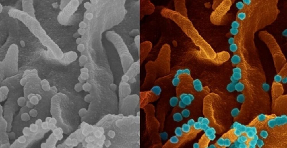 អ្នក​វិទ្យា​សាស្ត្រ​អាមេរិកាំង​ថត​បាន​រូបភាព​ COVID-19 កំពុង​ជ្រែក​ចេញ​ពី​កោសិកា​​ជិត​ងាប់