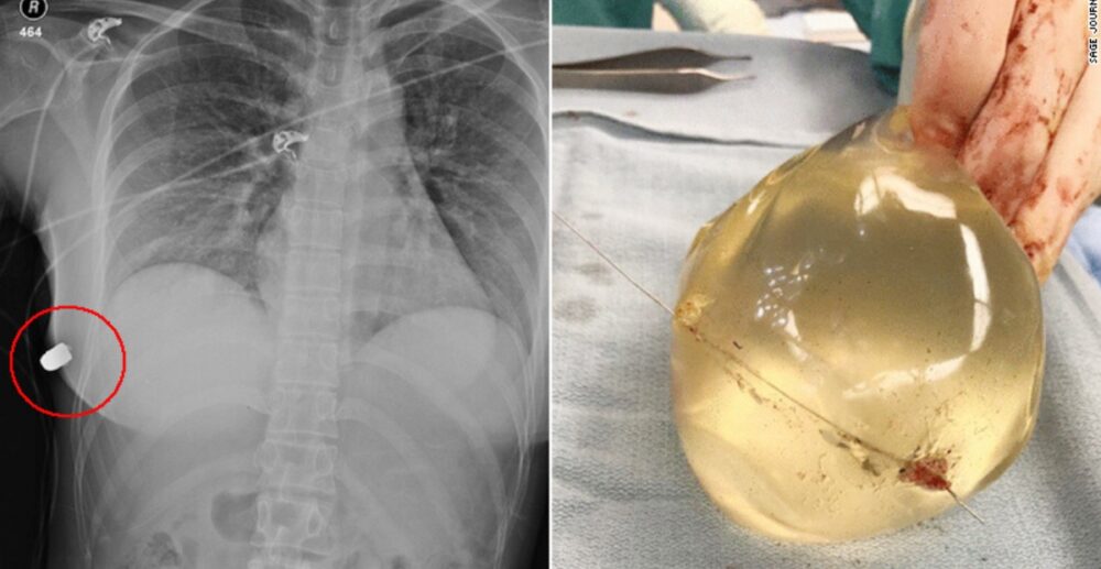 សុដន់ក្លែងក្លាយ ជួយសង្គ្រោះជីវិត…គ្រូពេទ្យប្រាប់ថា បានដុំស៊ីលីខូនជួយ អ្នករបួសរួចពីស្លាប់