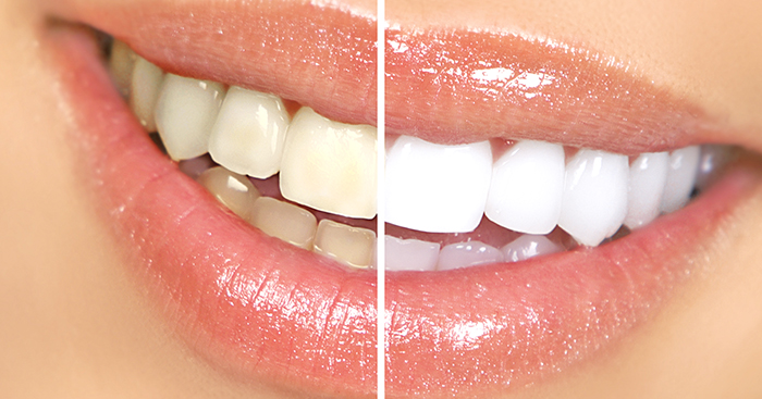 ចង់ “ធ្មេញស” ត្រូវដឹងគន្លឹះល្អៗដែលជួយអ្នកបាន