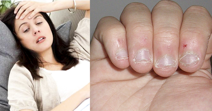 8 សញ្ញាដែលបង្ហាញថា រាងកាយខ្វះសារធាតុដែកហើយ