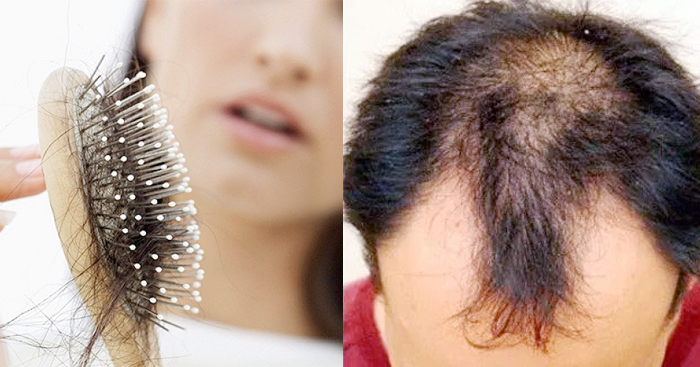 7 មូលហេតុដែលធ្វើ “សក់ជ្រុះ” ក្បាលទំពែក