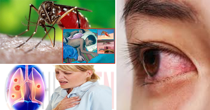 ប្រយ័ត្នទុកជាមុន…ជំងឺដែលនឹងមកជាមួយរដូវភ្លៀង