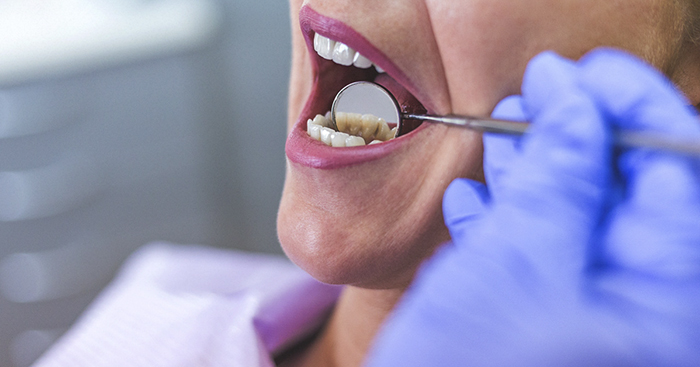 ជំនឿខុសៗ 9 រឿង ពាក់ព័ន្ធនឹងសុខភាពធ្មេញ ដែលយើងយល់ខុសមករហូត