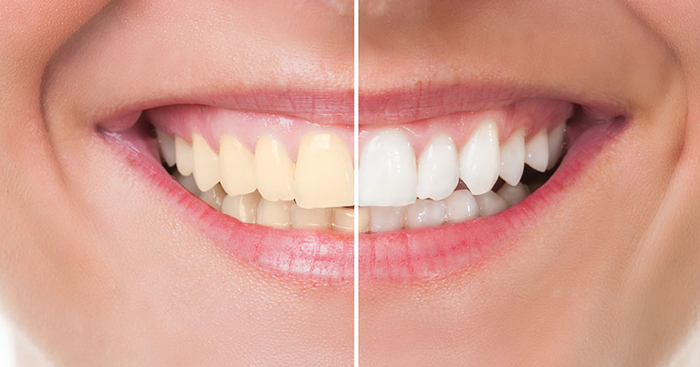 ហេតុអីត្រូវ “កេះកំណកកំបោរ” ចេញពីធ្មេញ និងមិនកេះចេញបានទេ?