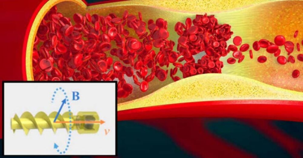 រ៉ូ​បូត​ដ៏​ល្អិត អាច​ហែល​នៅ​​ក្នុង​សរសៃ​ឈាម នាំ​ថ្នាំ​ទៅ​សម្អាត​ចំណុច​ដែលមាន​កំណក​ឈាម