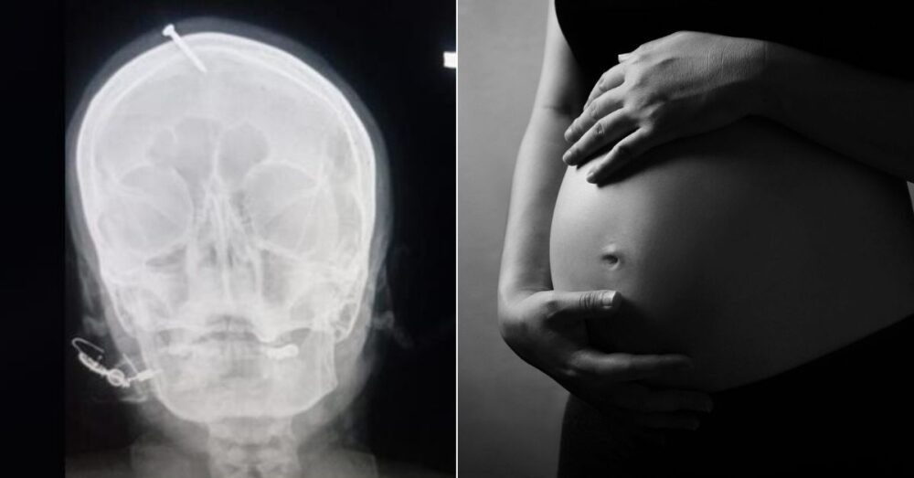 គ្រូ​​បុរាណ​​ដំ​​ដែក​គោល​​លើ​​ក្បាល​​ស្ត្រី​​ពពោះ​ ដើម្បី​​ធានា​ថា ​កូន​​ក្នុង​​ផ្ទៃ​​នឹង​…