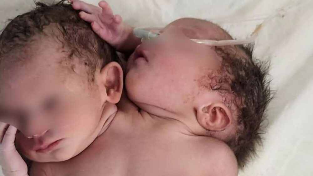 ករណី​ចម្លែក! ទារក​ចាប់​កំណើត​មក​មាន​ក្បាល​ពីរ និង​ដៃ​ដល់​ទៅ​បី 