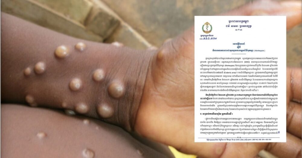 ជំងឺអុតស្វា (monkeypox) ! ក្រសួង​សុខាភិបាល​កម្ពុជា​ ណែនាំ​វីធាន​ការ​ទប់​ស្កាត់​ការ​ឆ្លង​ជំងឺ​នេះ