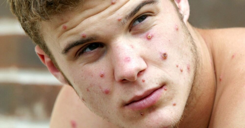 ពិភពលោក​រកឃើញ​ក​រ​ណី​ឆ្លង​ជំងឺ​អុត​ស្វា (monkeypox) ជាង ២០០ នាក់ហើយ!