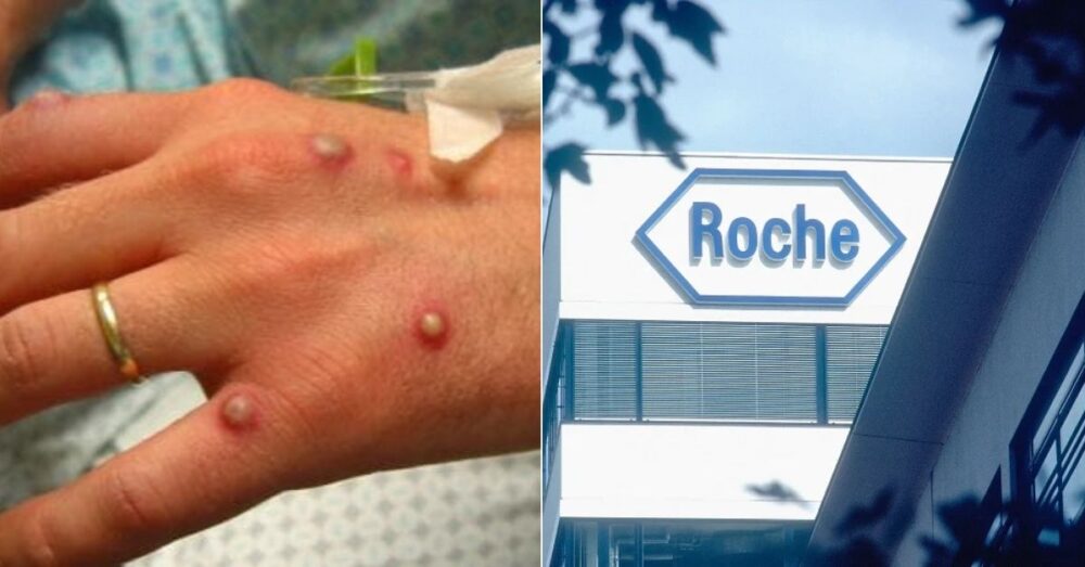 ក្រុមហ៊ុន​ឱសថ​របស់ ស្វ៊ី​ស អភិវឌ្ឍ​ឧបករណ៍ PCR សម្រាប់​តេស្តរ​កវី​រុស​អុត​ស្វា (monkeypox)