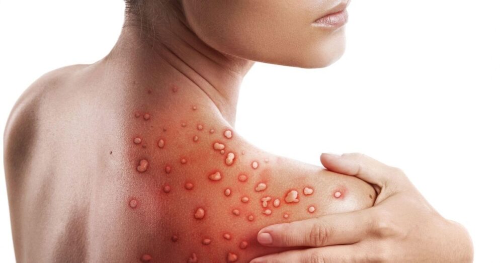 ករណី​ឆ្លង​ជំងឺ​អុត​ស្វា (monkeypox) នៅ កាណាដា និង សហរដ្ឋ​អាម៉េរិក បន្ត​កើនឡើង