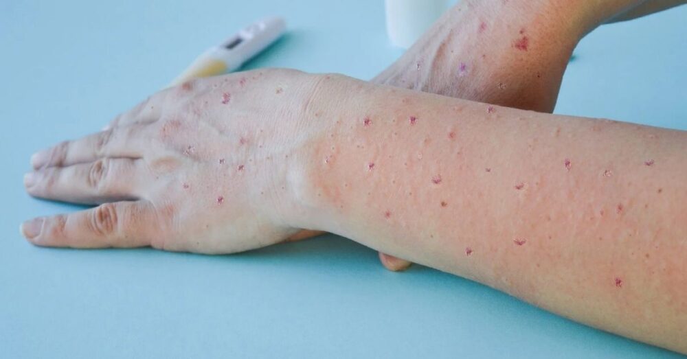 WHO ថា ជំងឺអុតស្វា (Monkeypox) បានឆ្លងដល់ ៣០ ប្រទេសហើយ!