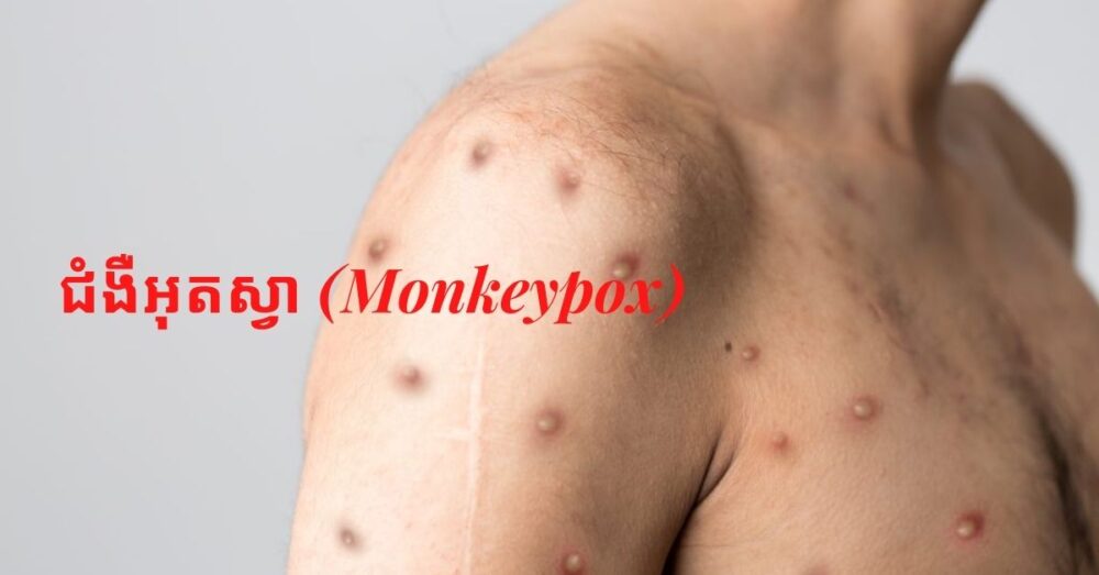 អង់គ្លេស បញ្ជាក់ថា ជំងឺ​អុត​ស្វា (monkeypox) ឆ្លង​ពី​មនុស្ស​ទៅ​មនុស្ស