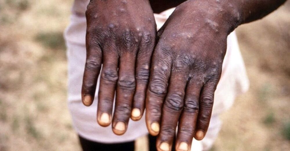 មជ្ឈមណ្ឌល​គ្រប់គ្រងជំងឺ​ឆ្លង​​ (CDC) អាម៉េរិក បង្កើន​​កម្រិត​​ប្រុង​ប្រយ័ត្ន​​ចំពោះ ​«ជំងឺ​អុត​ស្វា ​(Monkeypox)»