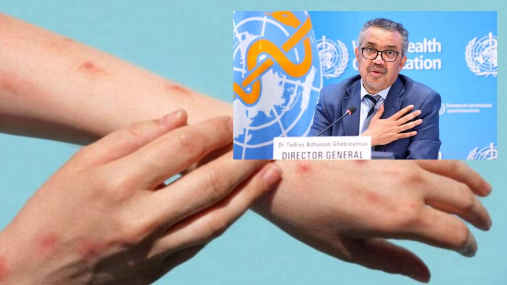 WHO ចេញប្រកាសទាក់ទិននឹងការចាត់ទុកជំងឺអុតស្វា (Monkeypox) ជាស្ថានភាពអាសន្នផ្នែកសុខាភិបាលសកល