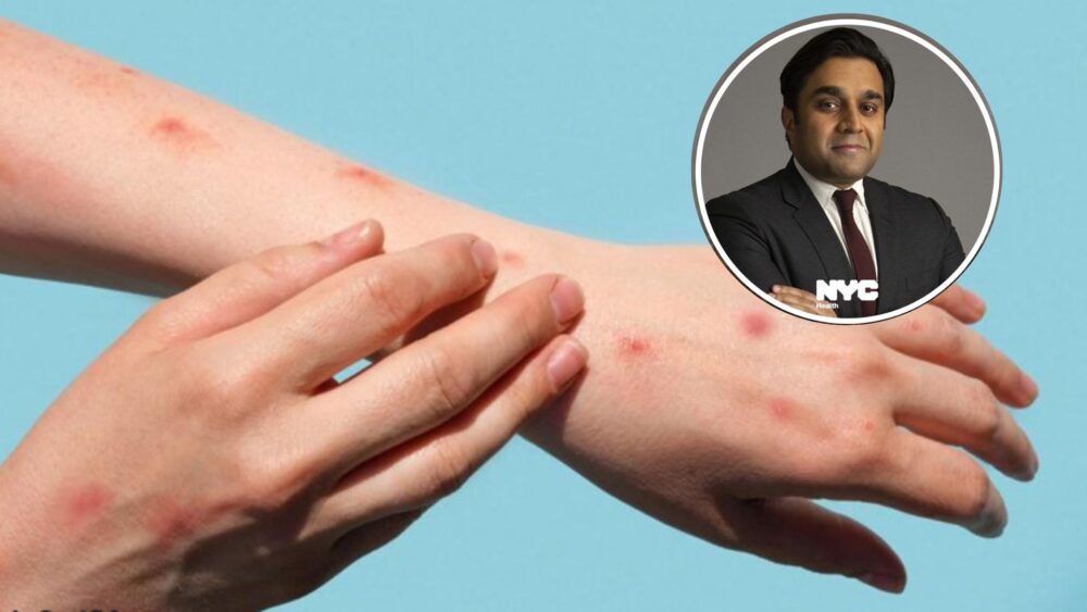 New York ស្នើឱ្យ WHO ប្ដូរ​ឈ្មោះ​ជំងឺ​អុត​ស្វា (Monkeypox)