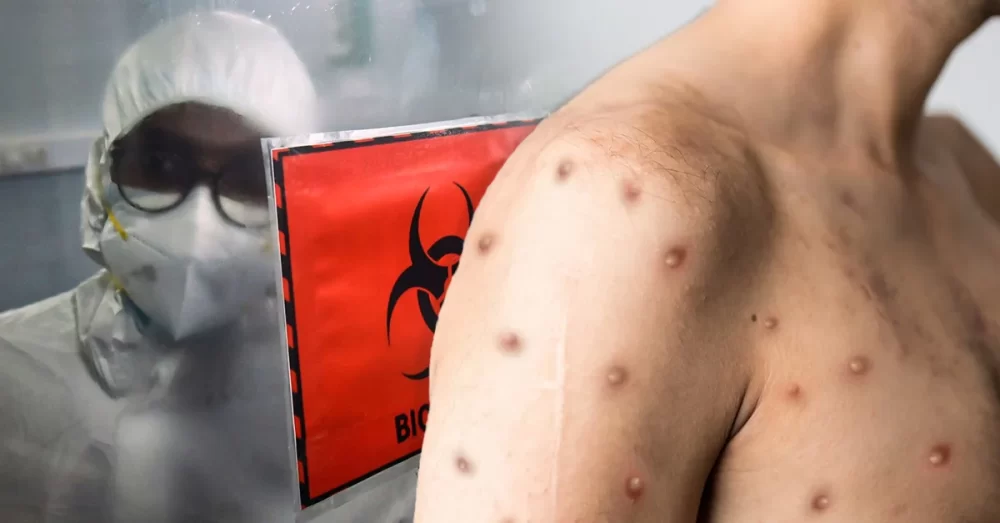 ករណី​ស្លាប់​ដោយសារ​ជំងឺ​អុត​ស្វា (Monkeypox) ដំបូង​គេ នៅ​ខាងក្រៅ​ទ្វីបអាហ្វ្រិក